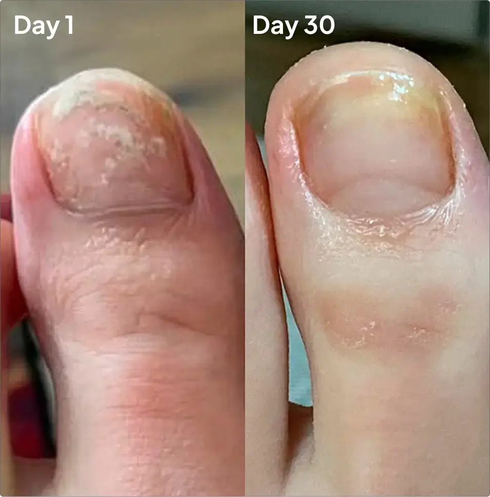 KlearNail Organic Antifungal Treatment