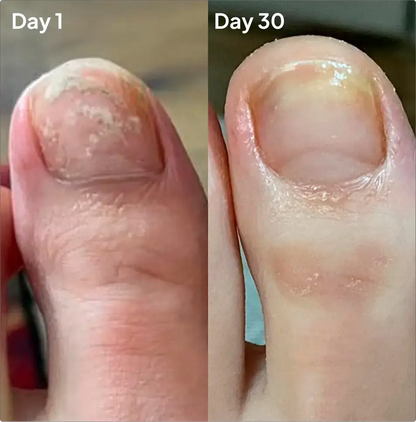 KlearNail Organic Antifungal Treatment